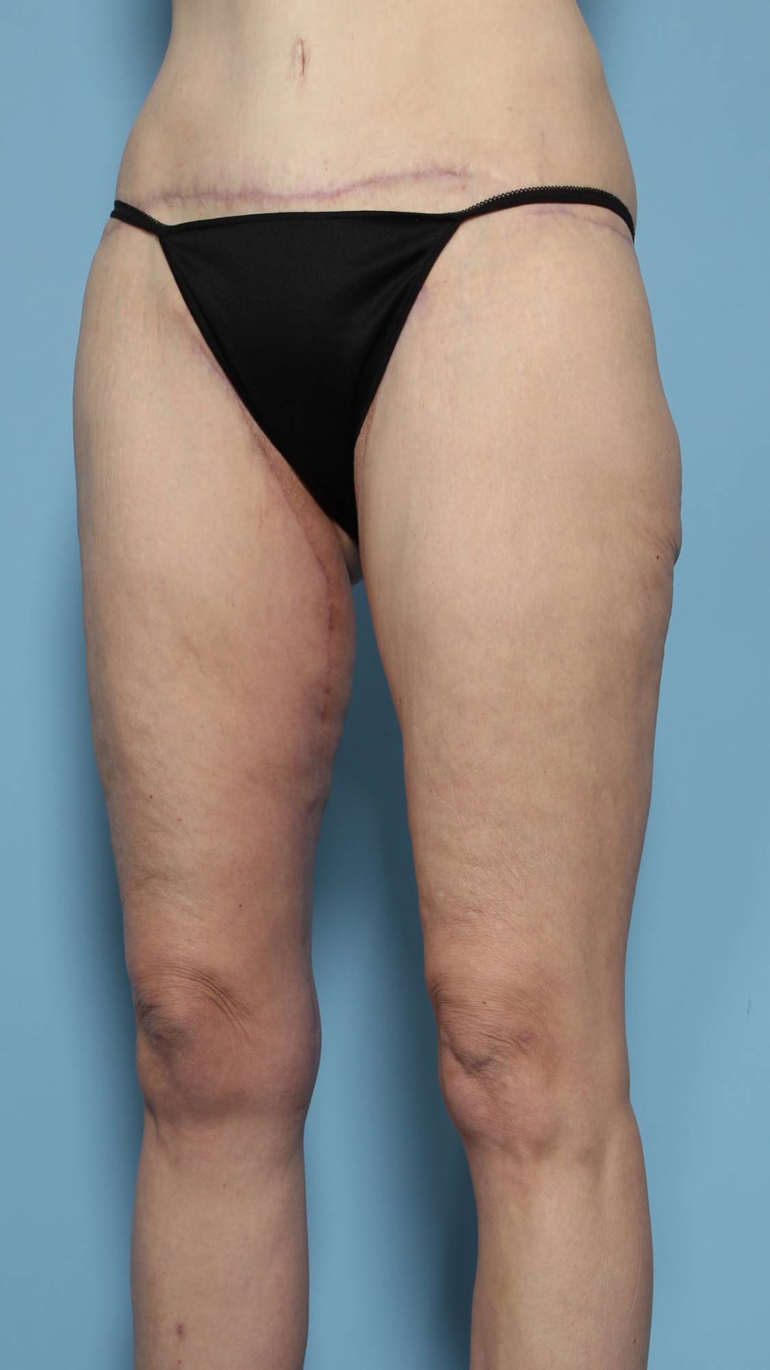Thigh Lift Before & After Image