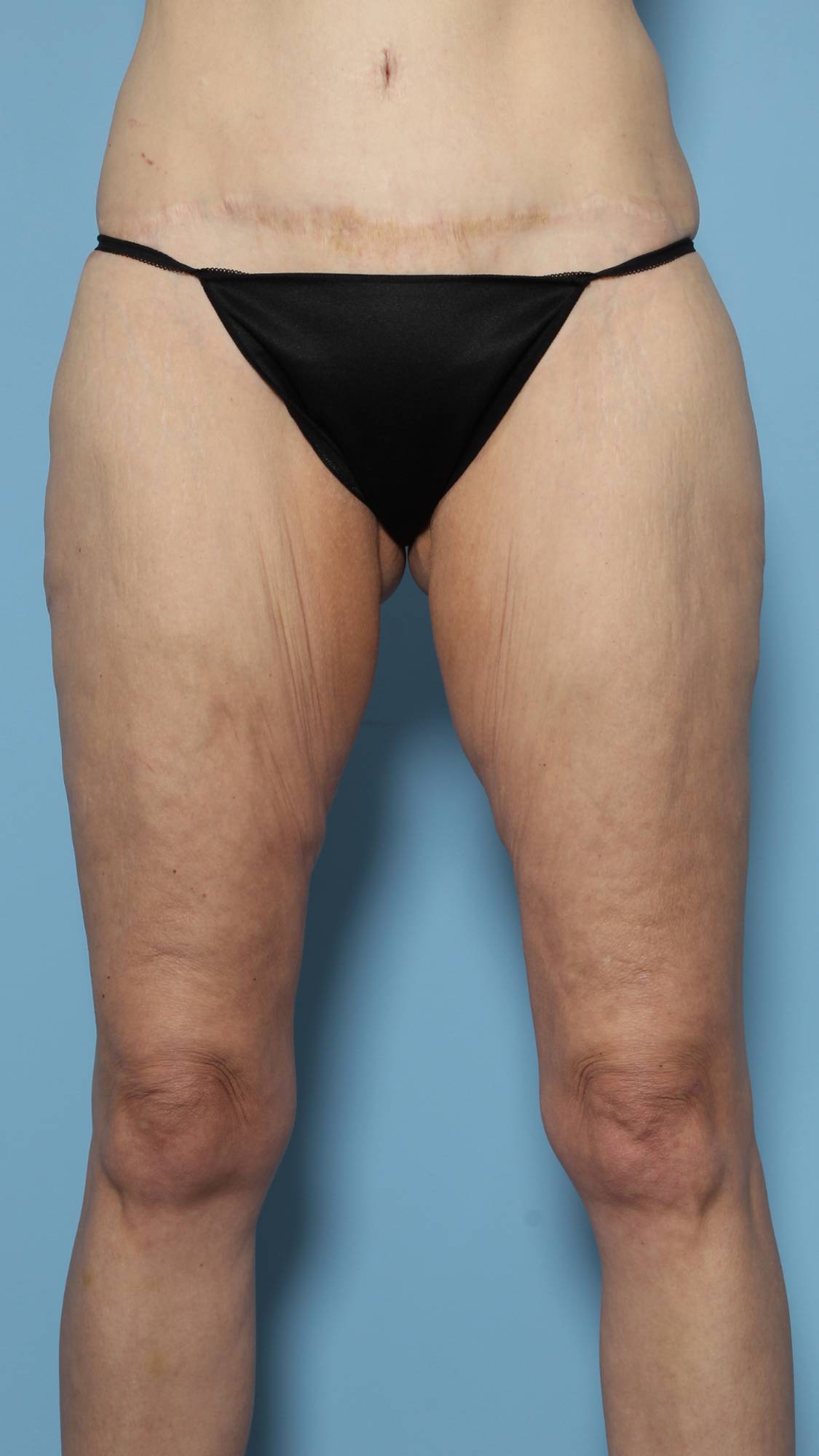 Thigh Lift Before & After Image