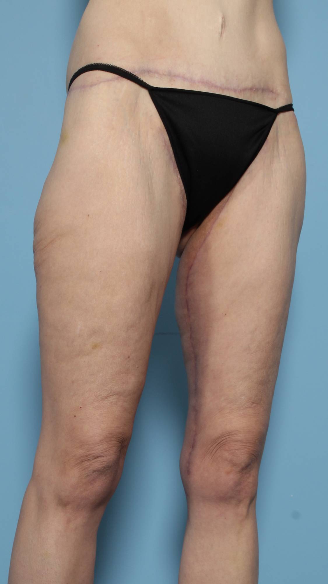 Thigh Lift Before & After Image