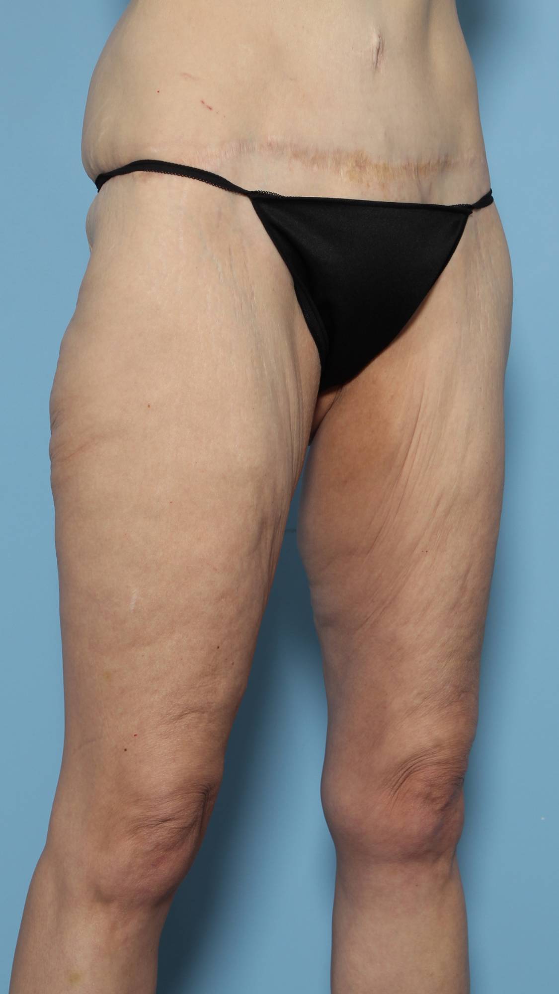 Thigh Lift Before & After Image