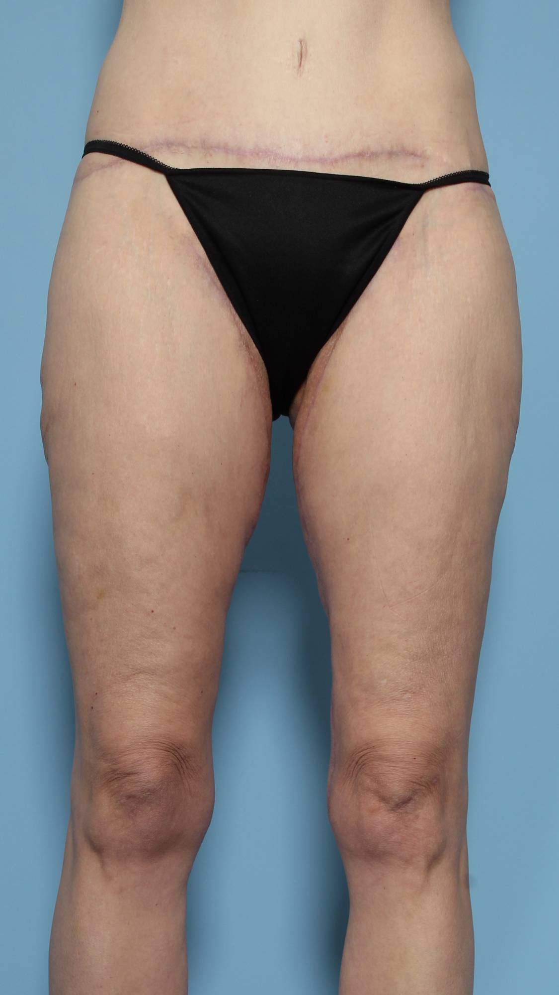 Thigh Lift Before & After Image