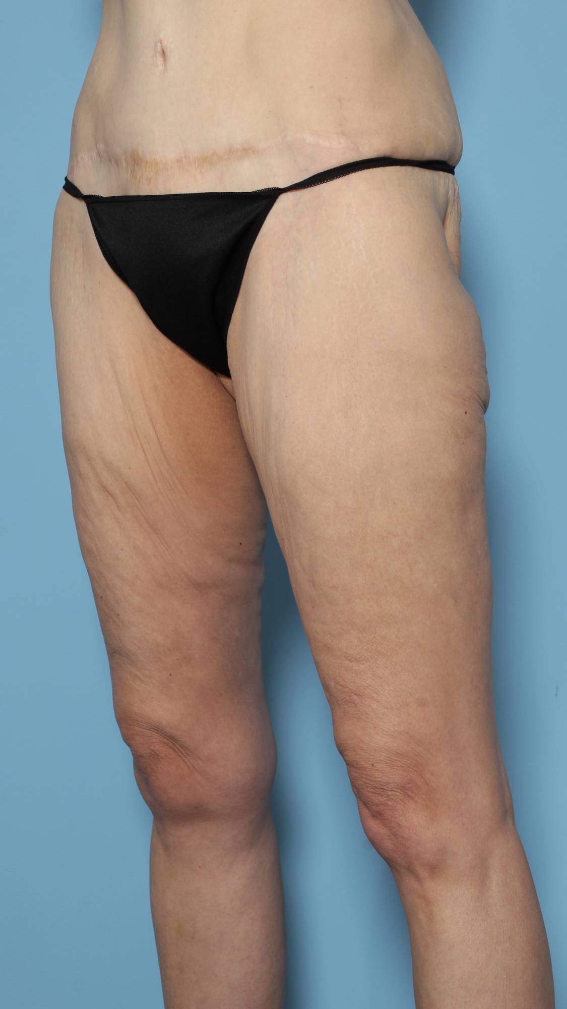 Thigh Lift Before & After Image